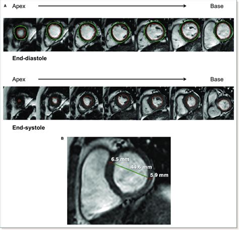 lv end diastolic diameter|left ventricular end diastolic diameter.